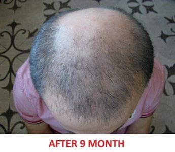 hair regrowth after 9 month photo 9 
month.jpg